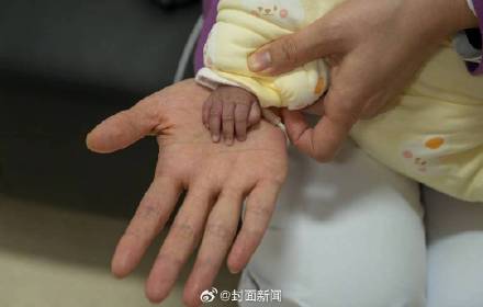 出生時僅650克的巴掌女嬰出院了