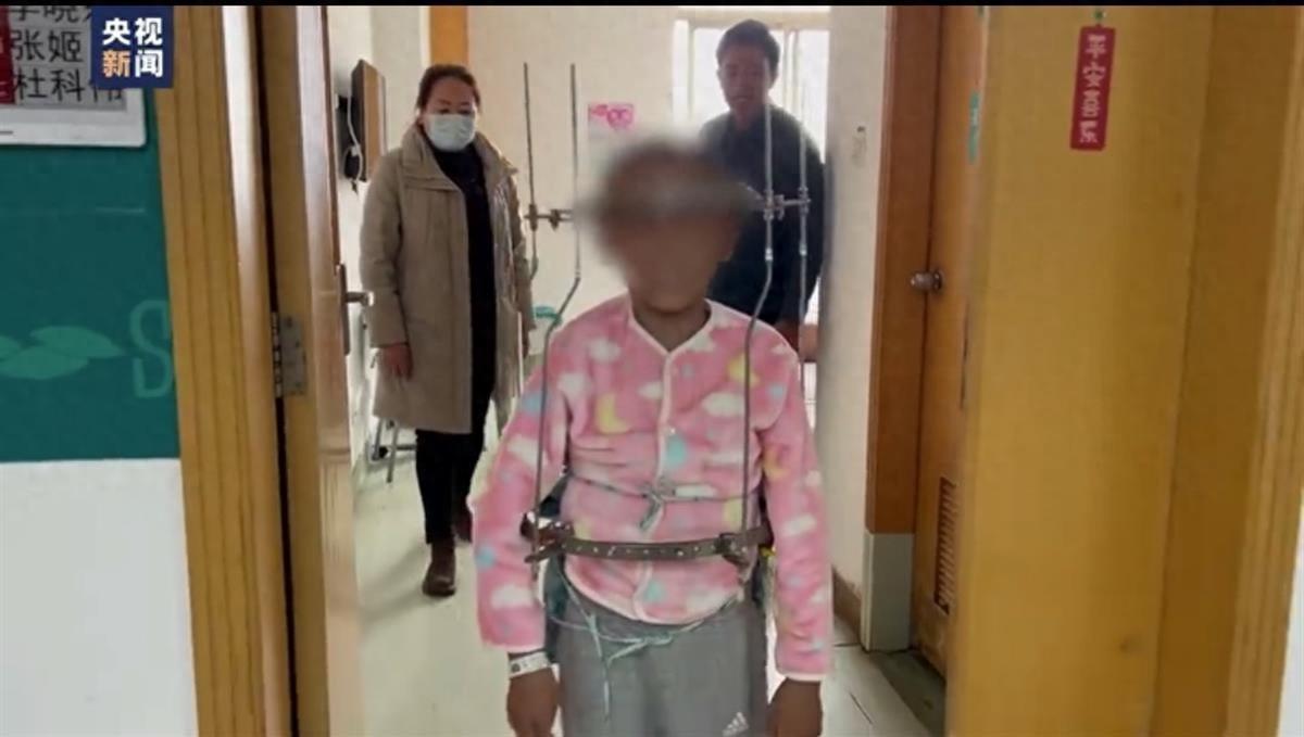 脊柱側彎女孩術后高了21厘米